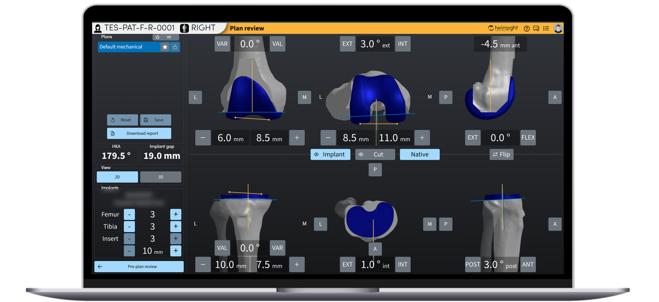 SurgiTwin plan review on a laptop: femur and tibia in three views with the planned cuts and implant sizes